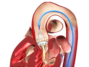tratamento estenose valvula aortica cateter